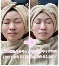 小顔✖️セルキュア