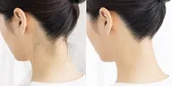 ꒰ レッスンモデル 3名様限定 ꒱ 女性うなじワックス脱毛♪