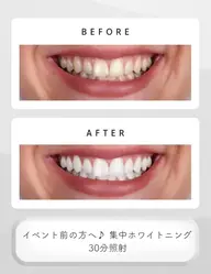 【イベントを控えてる方へ】集中ホワイトニング30分🦷
