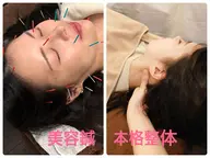 【おすすめNO.2❤️‍🔥】美容鍼×本格整体→ たるみ、しわ、肩こり、ストレートネック、猫背にお悩みの方へ