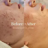 【全営業時間】フェイスライン大人ニキビ毛穴ケア!水素高周波のWアプローチ!フェイシャルエステ体験