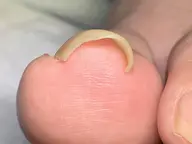 巻き爪補正
