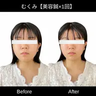 【U30限定】✨速攻小顔✨電気美容鍼