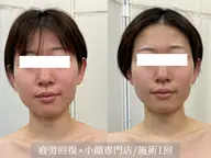 クイックコルギ+顔脱毛(70分)