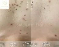 【デコルテハーブピーリング/剥離有•無】ニキビケア、色素◯着、毛穴、サメ肌、ニキビあと