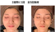DTなし👋🏻新世代ピーリング"バイオピール®"どんな肌質の方でも施術可能💆🏻♀️施術直後からお肌ツルピカ✨