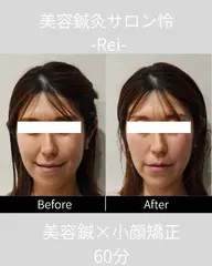 【5月限定3名様✨️人気No.1】スタンダード美容鍼コース＋選べる1種手技＋韓国式LED美顔器　60分