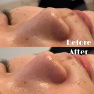 【限定3名🧖🏻‍♀️】本気でお肌変えたい方！ふわもち肌に♡毛穴すっきり洗浄体験🫧