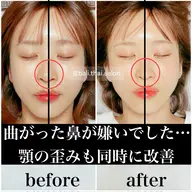 ミニモ学割＆モニター割！【鼻集中】鼻の歪み・曲がり・低い人向けプチ体験［小顔/鼻/頬骨/上顎骨］
