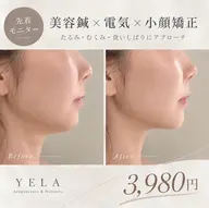 【先着モニター】美容鍼×電気×小顔矯正 3,980円