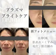 当店no.1メニュー【美白小顔】プラズマブライトケアポレーションOP付