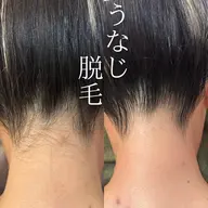 【学割U24✨】うなじ+背中上光脱毛【ミニモ学割】