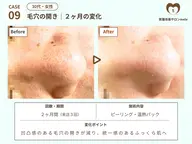 【9月中ご来店限定】 💆毛穴悩み専用💆黒ずみ・開き・ざらつきケア◎ 角質除去 +温熱パック