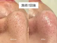 メンズ肌ケア(毛穴洗浄フェイスワックス)肌に組み合わせます！ザラザラしている／黒ずみがある／産毛多い方のみ無料撮影です！
