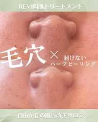 【毛穴の黒ずみ＆開きケア】剥けないハーブピーリング＆鼻集中毛穴洗浄+高濃度美容液導入付き　定価23650円