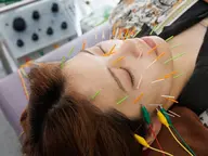 美容鍼！　(グーグルの口コミ投稿に協力していただける方限定)