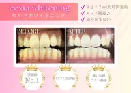 【人気NO.1】セルフホワイトニング(9分2セット)1回3,980円 → ¥980円　別途料金なし