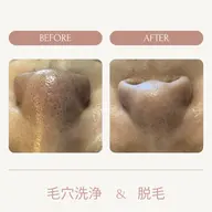 【鼻の黒ずみ洗浄&顔脱毛】黒ずみ除去◎毛穴洗浄が人気の顔脱毛とset!