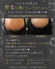 薄毛撲滅!育毛幹細胞スカルプジェット