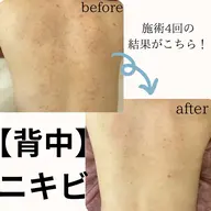 背中ニキビに!剥離有りハーブピーリング🌿
