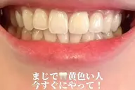🎀歯の黄ばみ撃退！🎀新メニュー‼️ホワイトニング美意識高めの方