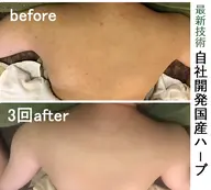 人気No.1!Exsハーブピーリング【二の腕背上or背中全部】90分24000円