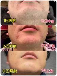 ヒゲ脱毛