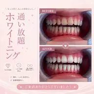 【定額⟡通い放題】🪞ᩚセルフホワイトニング ¥11,000/月
