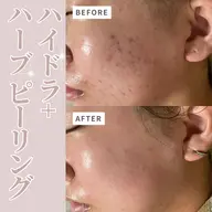 【満足度・即効性💖✨】水素ハイドラフェイシャル＋剥離なしハーブピーリング🌿🇰🇷パック付き