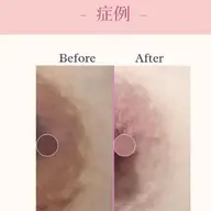 バストトップ　ピンクトーンケア