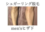 【メンズシュガーリング脱毛】　両ひざ下🦵¥9500