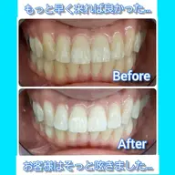 【再来】期間限定!もう一度セルフホワイトニング体験をしたい方😊✨10分照射×2回!
