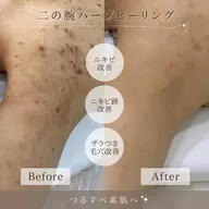 選べるボディハーブピーリング・剥離あり