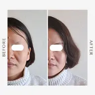 【当店人気No.2🏅鍼灸×エステ】小顔～身体・頭までほぐして流して整える鍼灸BODY & 血巡りリフト美容鍼