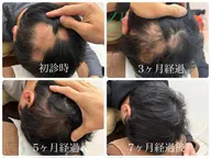 【人気NO.1】月3名限定カウンセリング＆ 初回体験 育毛促進鍼27500円→4980円/抜け毛/薄毛/細毛/円形脱毛症