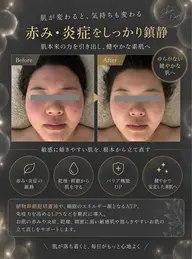 即日赤み鎮静!もち肌幹細胞トリートメント