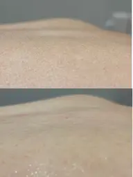 360度美しく★うなじ+背中ワックス脱毛セット♪