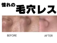 【毛穴撲滅】1回でも効果抜群◎毛穴れすな美肌が叶うスペシャルケア★美肌顔脱毛+毛穴洗浄¥6600