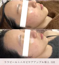 ララピール+美容液導入で頑固なニキビ跡や繰り返すニキビ肌に優しくアプローチ💆♀️✨