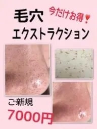毛穴エクストラクション