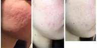 ニキビ肌★ケア美肌フェイシャルエステ