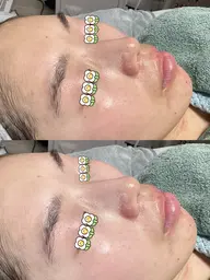 ツルツル白玉水光肌毛穴洗浄フェイシャルコース【メンズにもおすすめ】