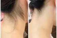 うなじ･背中脱毛🌱見えない箇所も美しく🎀