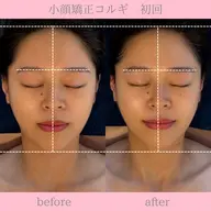 ミニモ限定クーポン✺⋆*小顔矯正コルギ+上半身マッサージ付🉐顔歪み矯正◎ほうれい線◎