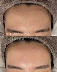 【フェイス人気No.1】★女性フェイスワックス+光脱毛/※眉デザイン無し(要口コミ)