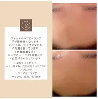 美肌フォトセラピー シミ、リフトアップ