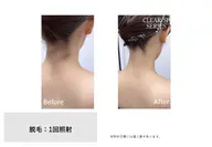 うなじ+首脱毛 アップにした時の後ろ姿がスッキリきれいに♡首も長く見えます。しっかり形を相談しながら照射していきます。