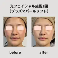【光フェイシャル】様々な肌悩みに◎プラズマパールリフト1回