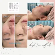【肌活6周年キャンペーン】フォトRFフェイシャル+ヒト幹細胞導入!!毛穴レスへ✨小顔美容液仕上げ✨️