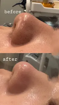 💆🏻♀️毛穴フェイシャルエステ💆🏻♀️ 練習モデル募集中!肌診断付き💚